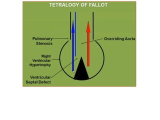 P trunk Aorta
Spiral septum
 
