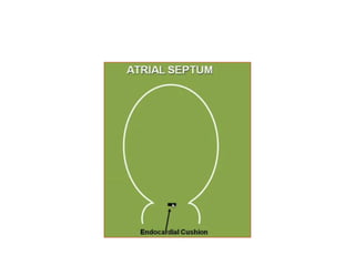 Ostium secundum
Cell death in upper part of septum primum before its
closing produce ostium secundum.
 