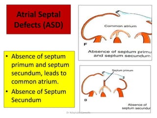 Atrial Septal
Defects (ASD)
• Absence of septum
primum and septum
secundum, leads to
common atrium.
• Absence of Septum
Secundum
Dr Ndayisaba Corneille
 