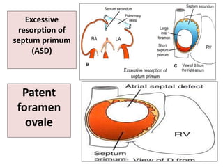 Excessive
resorption of
septum primum
(ASD)
Patent
foramen
ovale
Dr Ndayisaba Corneille
 