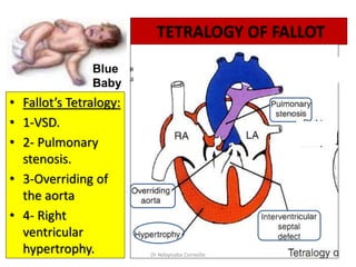 TETRALOGY OF FALLOT
• Fallot’s Tetralogy:
• 1-VSD.
• 2- Pulmonary
stenosis.
• 3-Overriding of
the aorta
• 4- Right
ventricular
hypertrophy.
Blue
Baby
Dr Ndayisaba Corneille
 