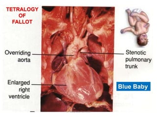 TETRALOGY
OF
FALLOT
Blue Baby
Dr Ndayisaba Corneille
 