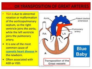 (TGA) OR TRANSPOSITION OF GREAT ARTERIES
• TGA is due to abnormal
rotation or malformation
of the aorticopulmonary
septum, so the right
ventricle joins the aorta,
while the left ventricle
joins the pulmonary
artery.
• It is one of the most
common cause of
cyanotic heart disease in
the newborn.
• Often associated with
ASD or VSD.
Blue
Baby
Dr Ndayisaba Corneille
 