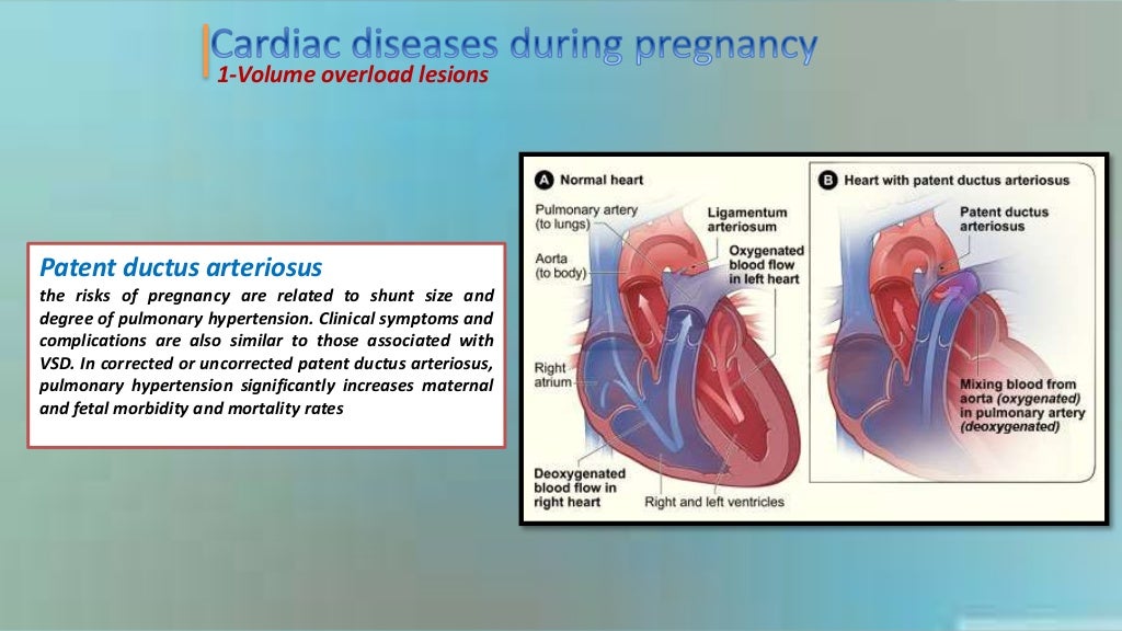 Heart disease during pregnancy