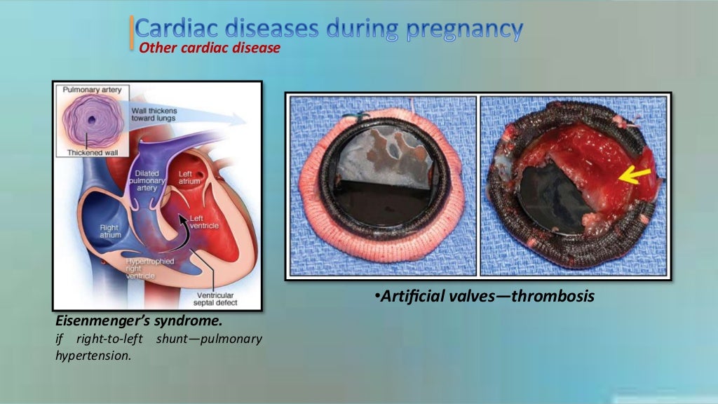 Heart disease during pregnancy