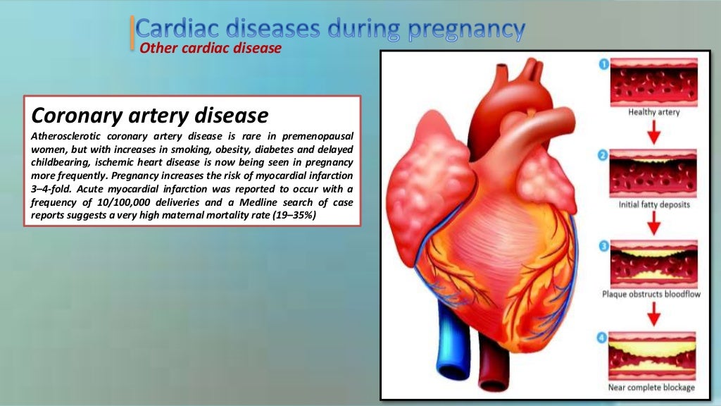 Heart disease during pregnancy