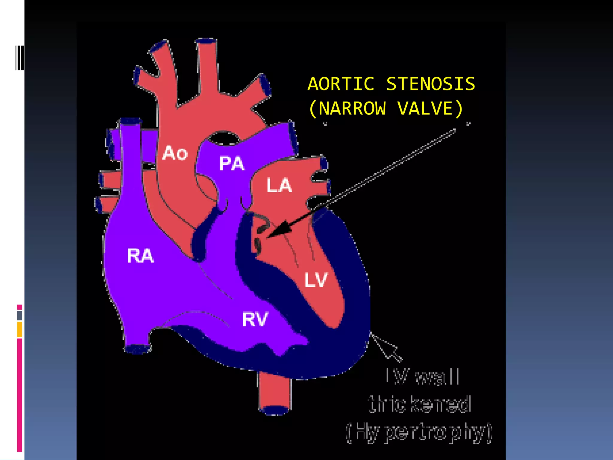 Classification of Heart Disease in Pregnancy | PPT