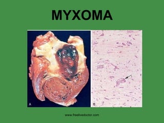 MYXOMA www.freelivedoctor.com 
