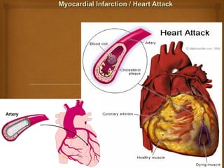 Myocardial Infarction / Heart AttackMyocardial Infarction / Heart Attack
 