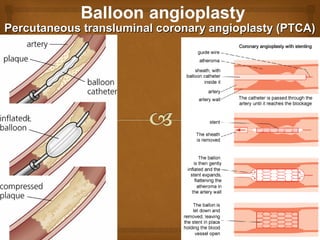 Percutaneous transluminal coronary angioplasty (PTCA)Percutaneous transluminal coronary angioplasty (PTCA)
 