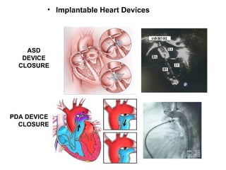 BASIC OF HEART DISEASE | PPT