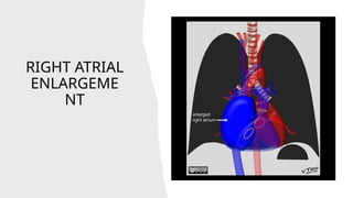 Radiology contenital heart disease Enlargement.pptx