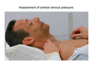 Assessment of central venous pressure.
 