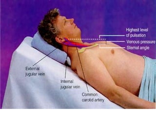 • Top line – level of the higest visible point of
distention
• Bottom line – level of the sternal angle
• Measure: the vertical distance between the
sternal angle and the highest level of jugular
distention
 