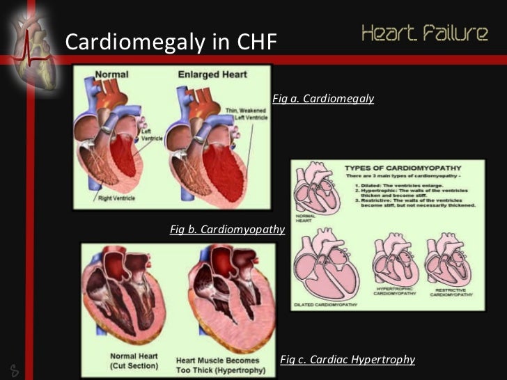 What is cardiomegaly?