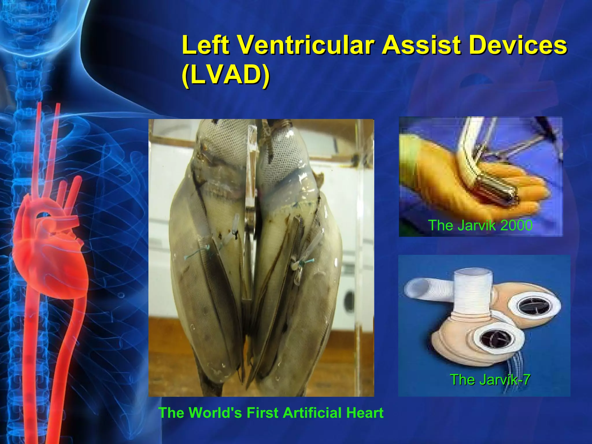 Left Ventricular Assist Devices (LVAD) The Jarvik-7 The Jarvik 2000   The World's First Artificial Heart 