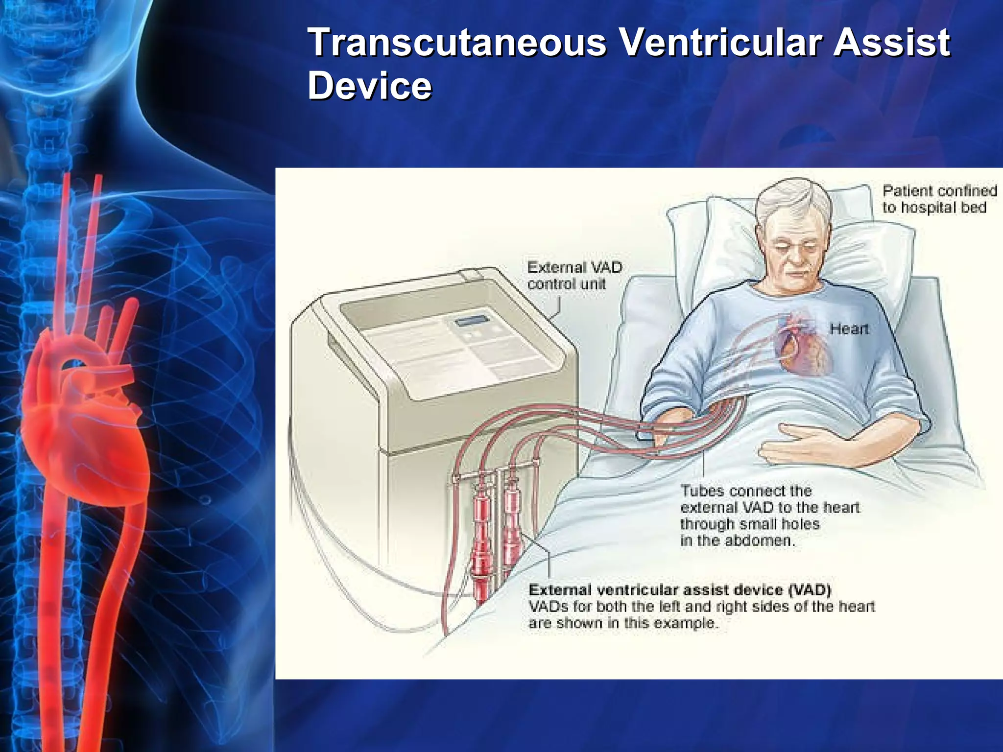 Transcutaneous Ventricular Assist Device 