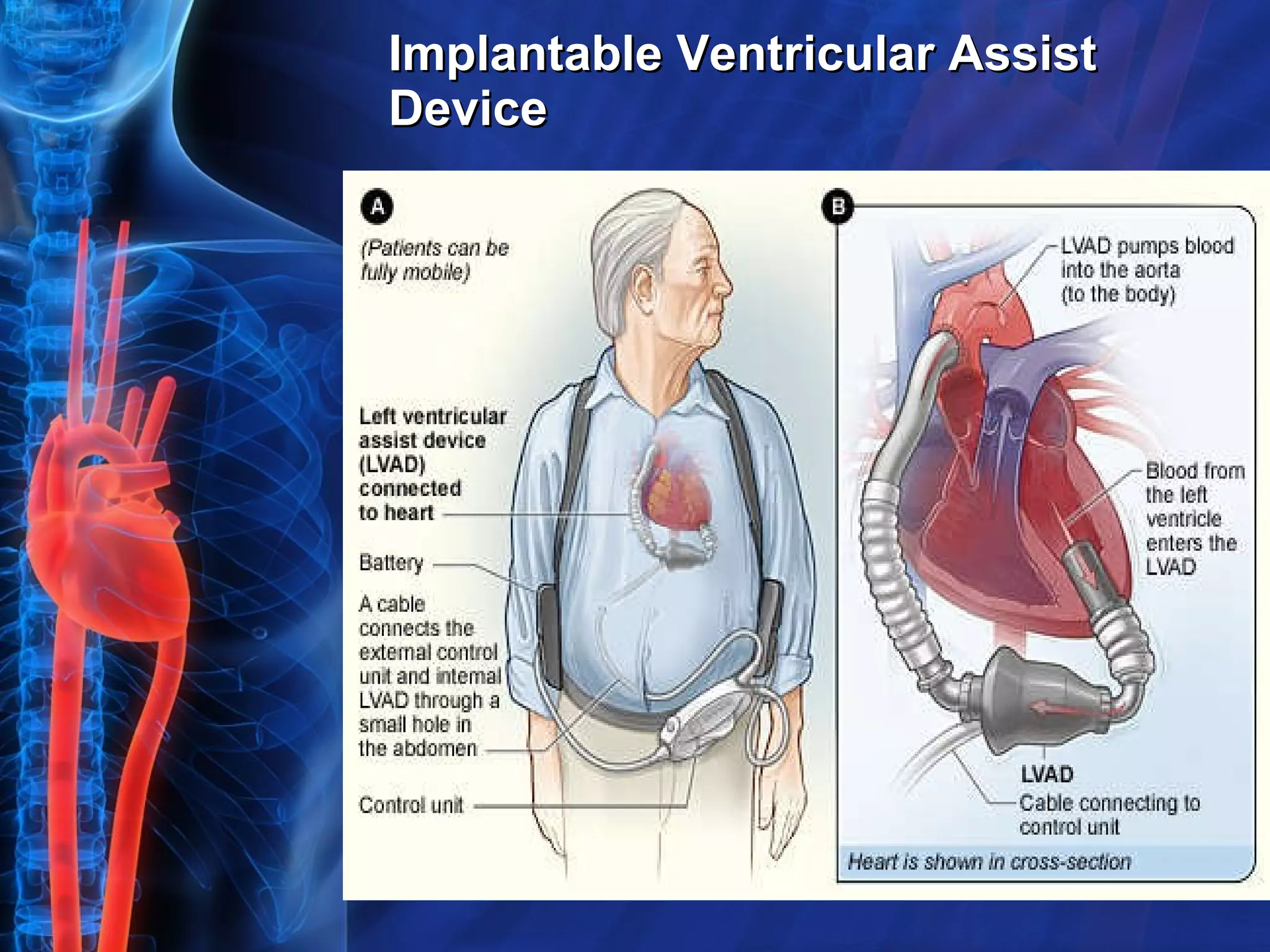 Implantable Ventricular Assist Device 