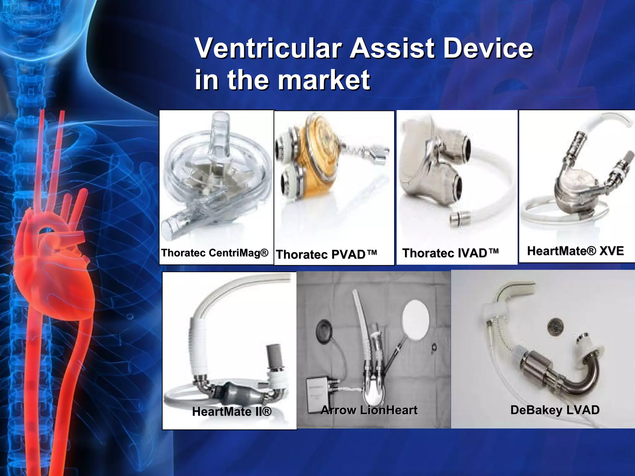 Ventricular Assist Device in the market HeartMate II® Arrow LionHeart   DeBakey LVAD   Thoratec CentriMag® Thoratec PVAD™ Thoratec IVAD™ HeartMate® XVE 