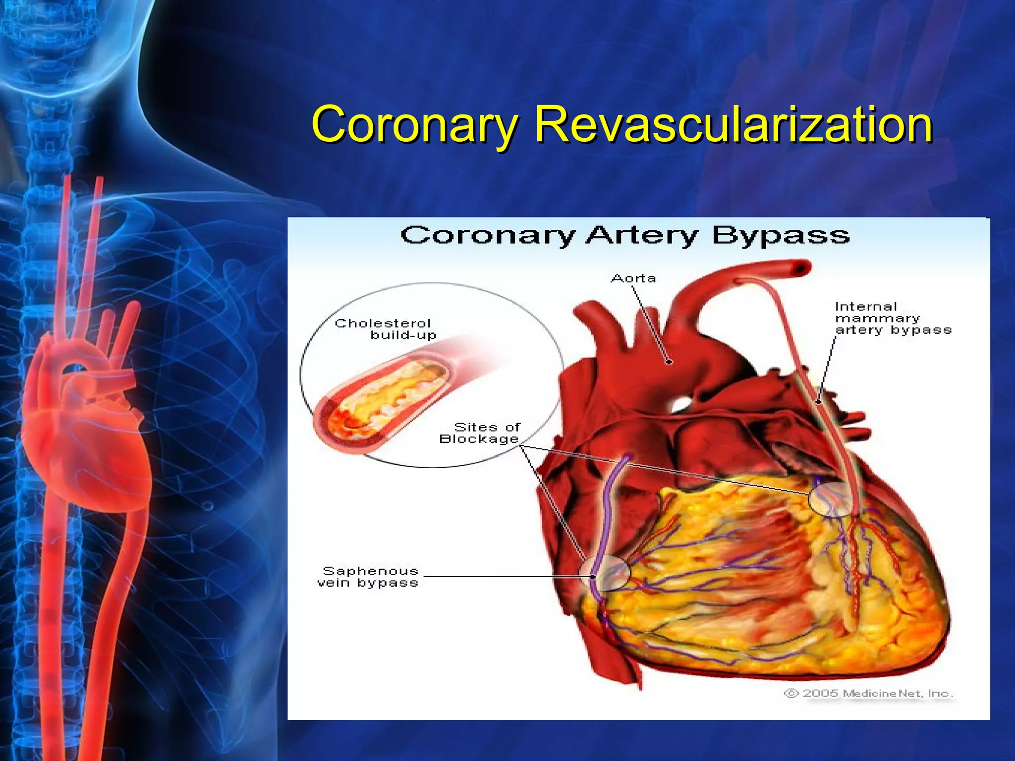 Coronary Revascularization 