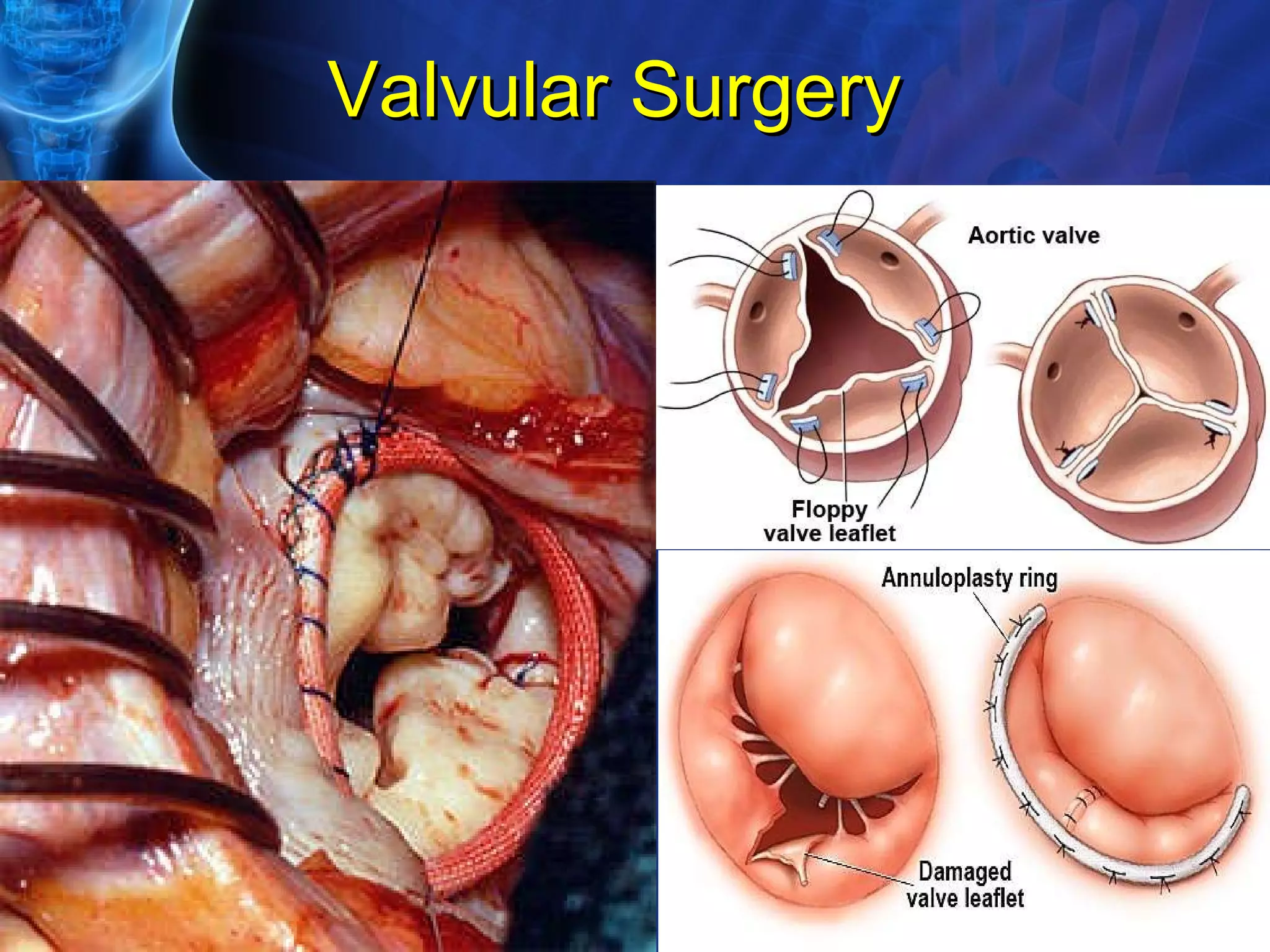 Valvular Surgery 