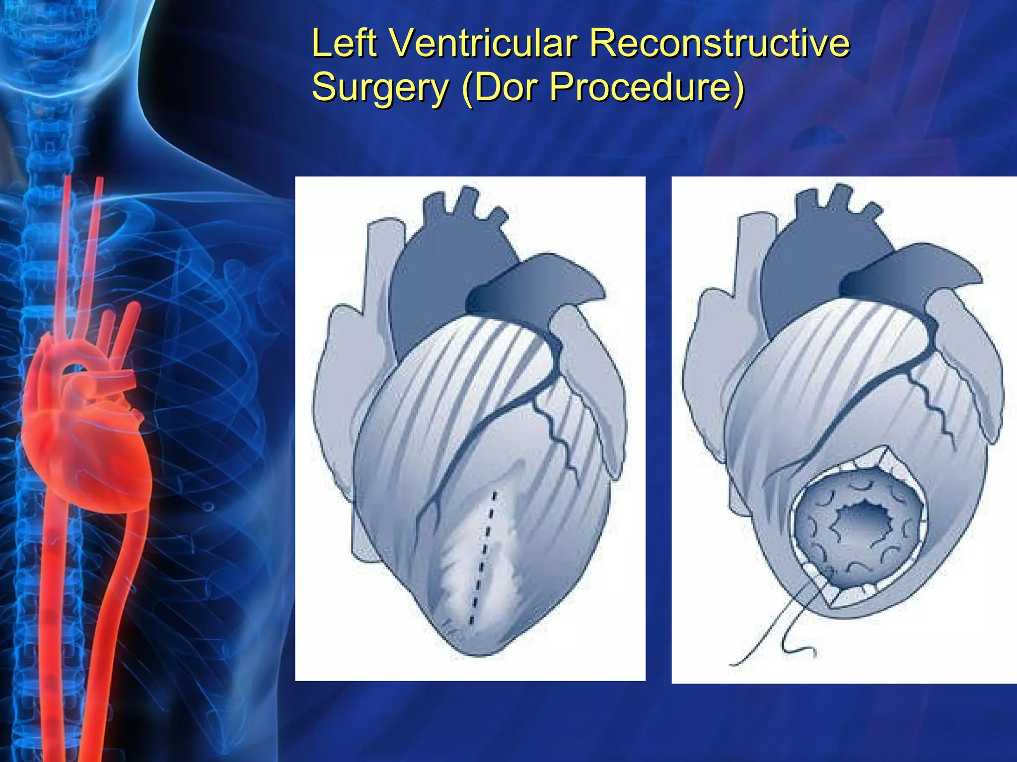 Left Ventricular Reconstructive Surgery (Dor Procedure) 