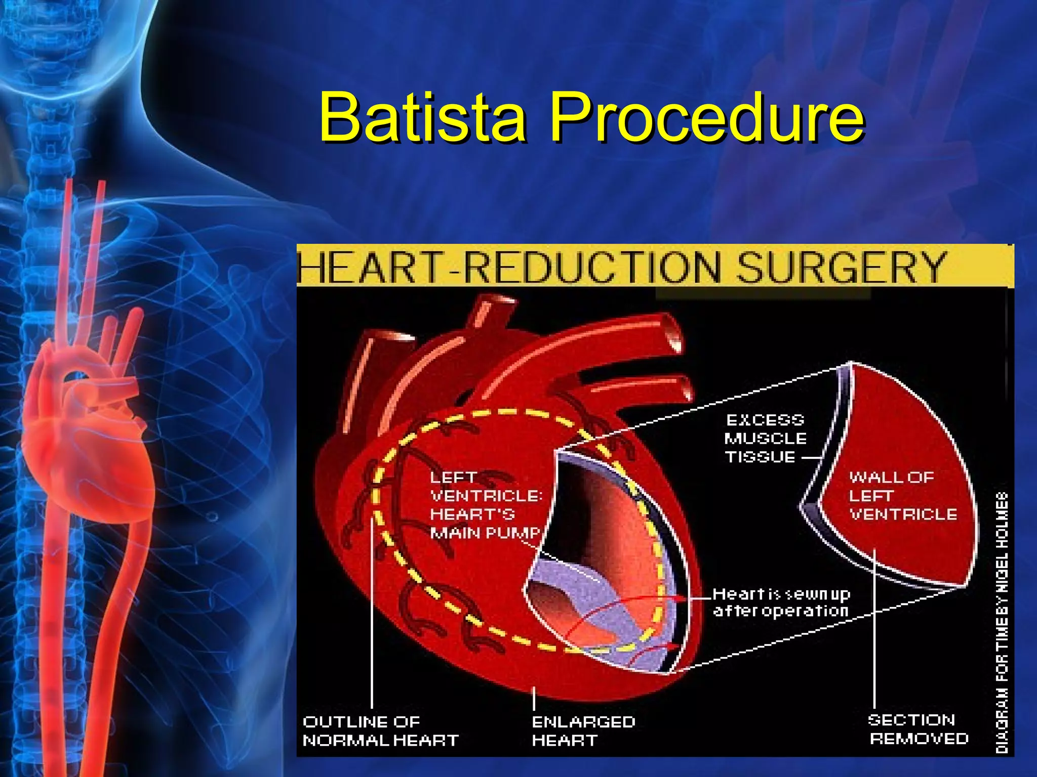 Batista Procedure 