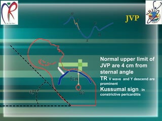 JVP Normal upper limit of JVP are 4 cm from sternal angle TR  V wave  and Y descend are prominent Kussumal sign  in constrictive pericarditis 