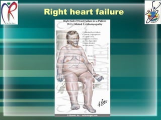 Right heart failure 