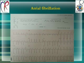 Atrial fibrillation 