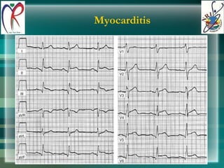 Myocarditis 