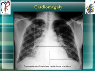Cardiomegaly 