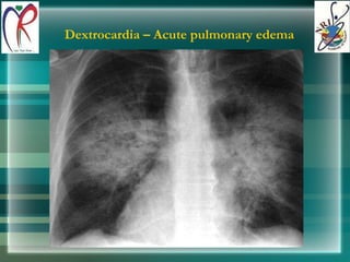Dextrocardia – Acute pulmonary edema 