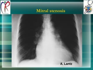 Mitral stenosis 