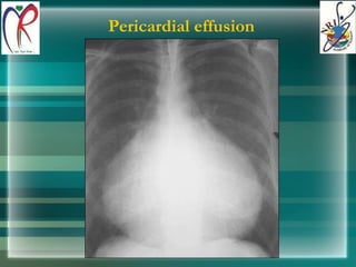 Pericardial effusion 