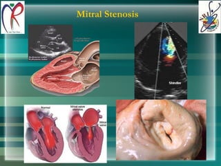 Mitral Stenosis 