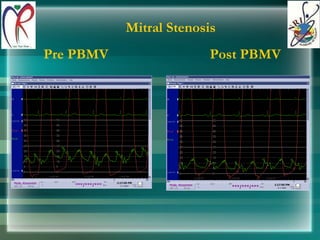 Mitral Stenosis Pre PBMV Post PBMV 