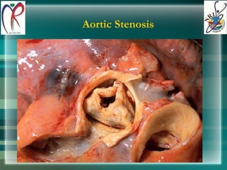 Aortic Stenosis 