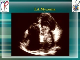 LA Myxoma 