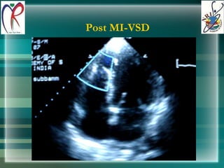 Post MI-VSD 