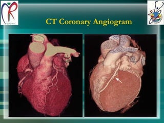 CT Coronary Angiogram 