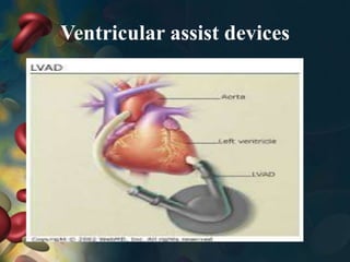 Ventricular assist devices
 