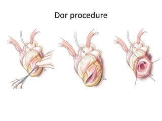Dor procedure
 