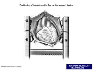 Positioning of the Apicorn CorCap cardiac support device.
© 2005 European Society of Cardiology
 
