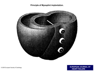 Principle of Myosplint implantation.
© 2005 European Society of Cardiology
 
