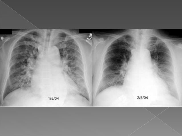acute atrial flutter icd 10 acute atrial flutter icd 10