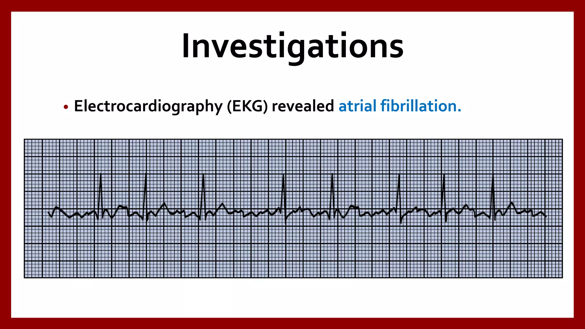 Investigations
• Electrocardiography (EKG) revealed atrial fibrillation.
 