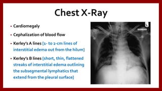 Chest X-Ray
• Cardiomegaly
• Cephalization of blood flow
• Kerley’s A lines [1- to 2-cm lines of
interstitial edema out from the hilum]
• Kerley’s B lines [short, thin, flattened
streaks of interstitial edema outlining
the subsegmental lymphatics that
extend from the pleural surface]
 