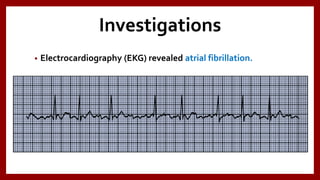Investigations
• Electrocardiography (EKG) revealed atrial fibrillation.
 