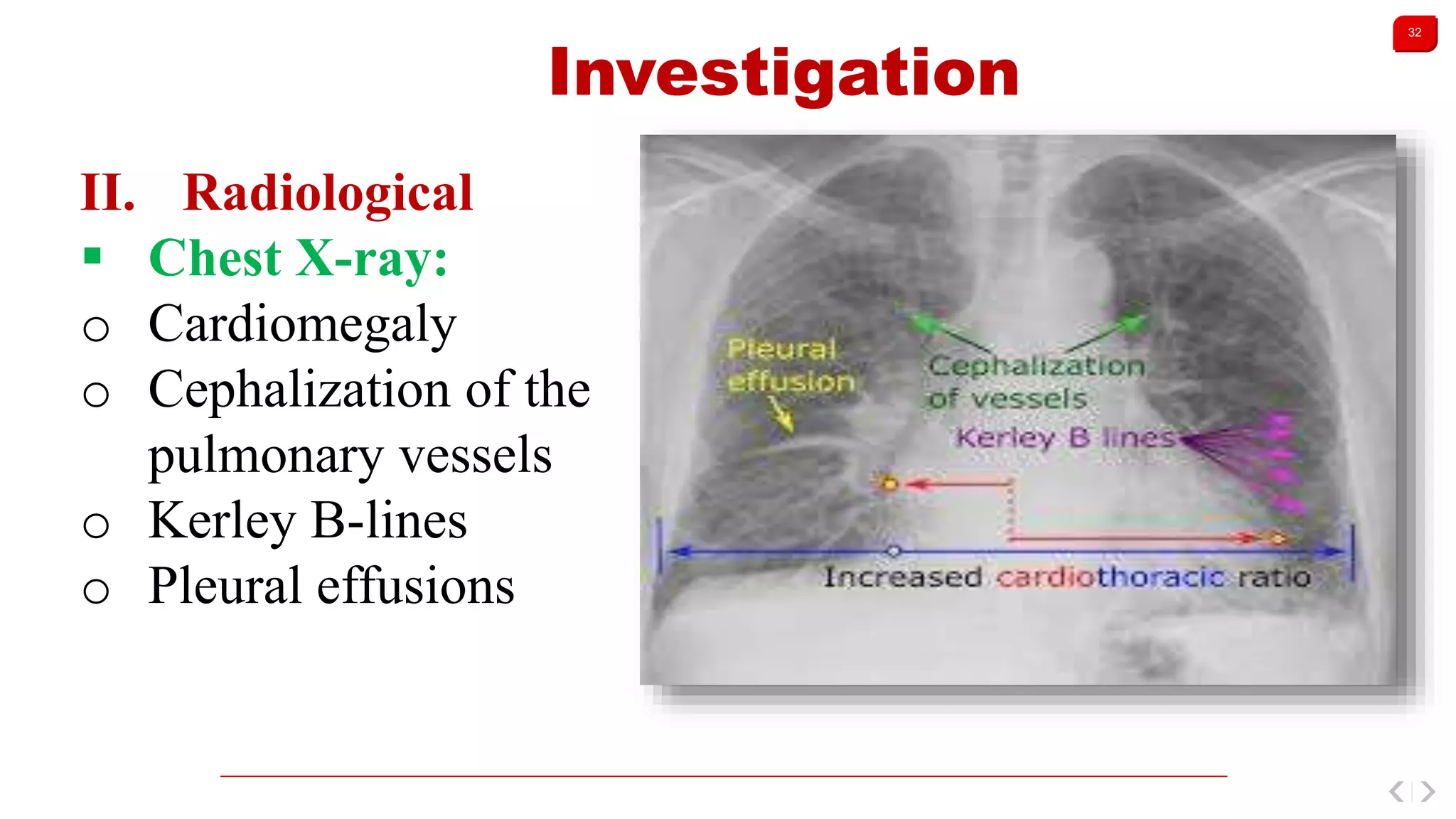 32
Investigation
II. Radiological
 Chest X-ray:
o Cardiomegaly
o Cephalization of the
pulmonary vessels
o Kerley B-lines
o Pleural effusions
 